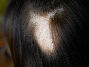 Hair Loss Alopicia treatments in Rugby