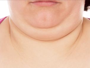 Double chin and beauty treatments in Rugby