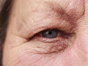 Hooded eyes treatments in Warwickshire